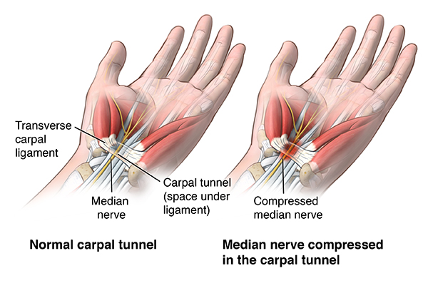 Carpal Tunel Syndrome 