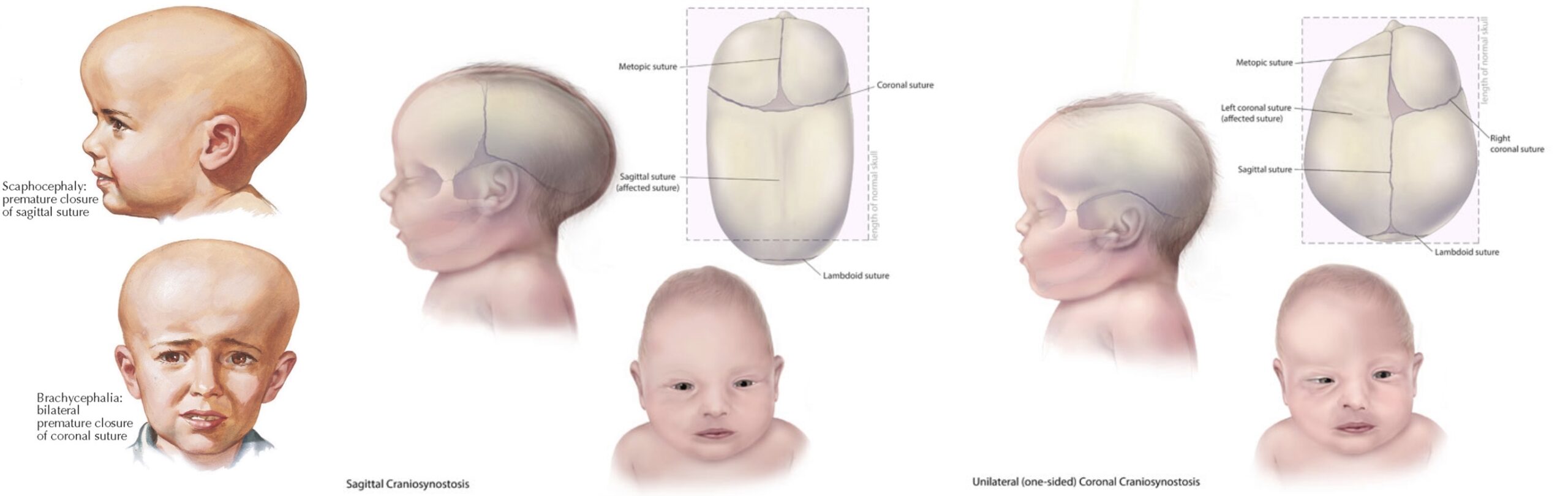 Craniosynostosis 