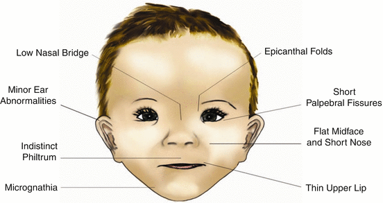 Birth Defect Paediatric
