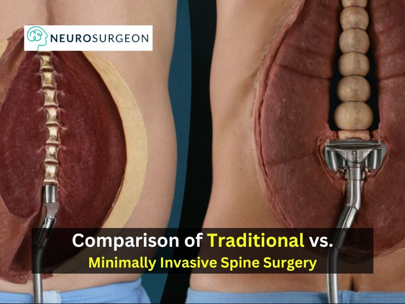 Traditional vs. Minimally Invasive Spine Surgery - Dr. Amit Deora Neurosurgeon in Indore