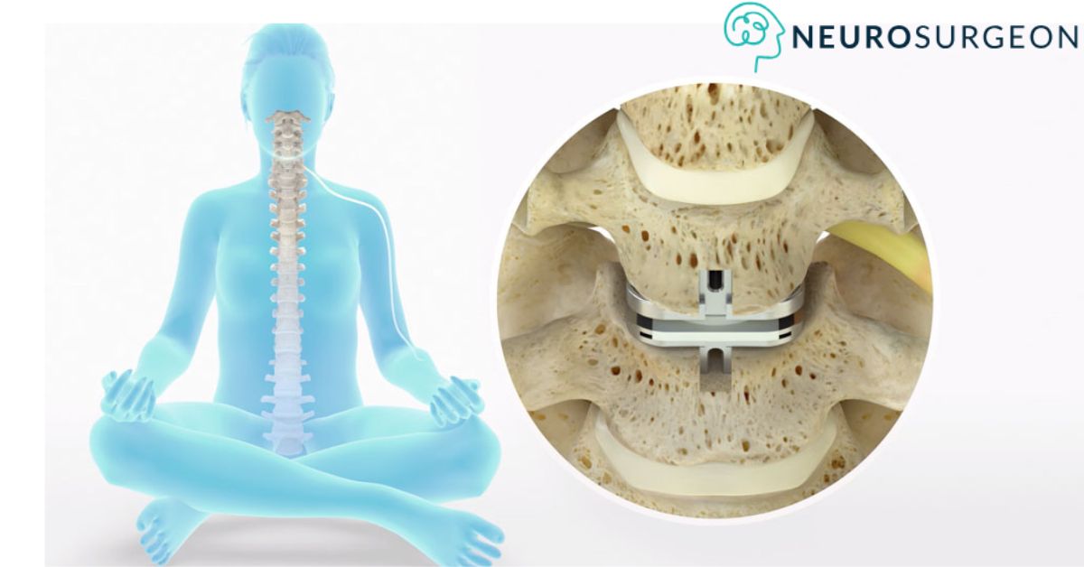 Benifits Of Disc Replacement Surgery by Best Spine Surgeon in Indore