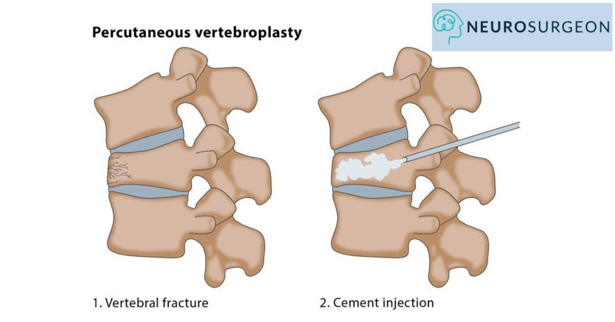 Spinal Fracture Treatment By Dr Amit Deora a Best Neurosurgeon Doctor In Indore