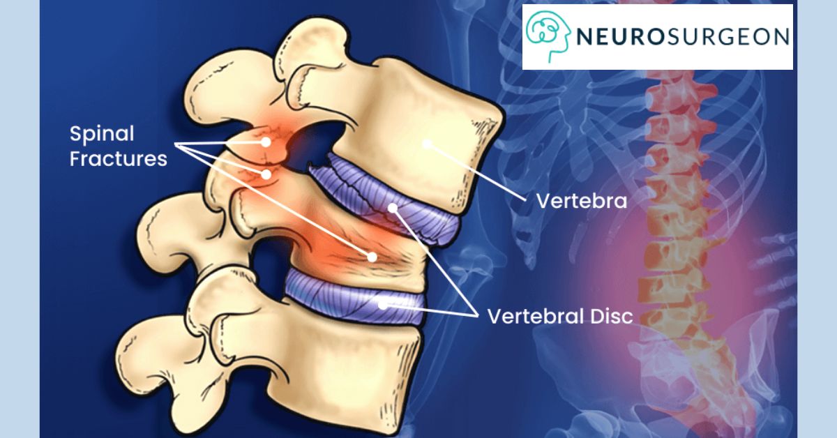 Spine Fracture-Dr Amit Deora-Best Neurosurgeon Doctor In Indore