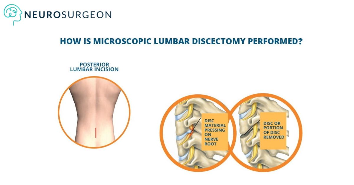 microscopic-lumbar-discectomy-Dr Amit Deora- Top Neurologist In Indore