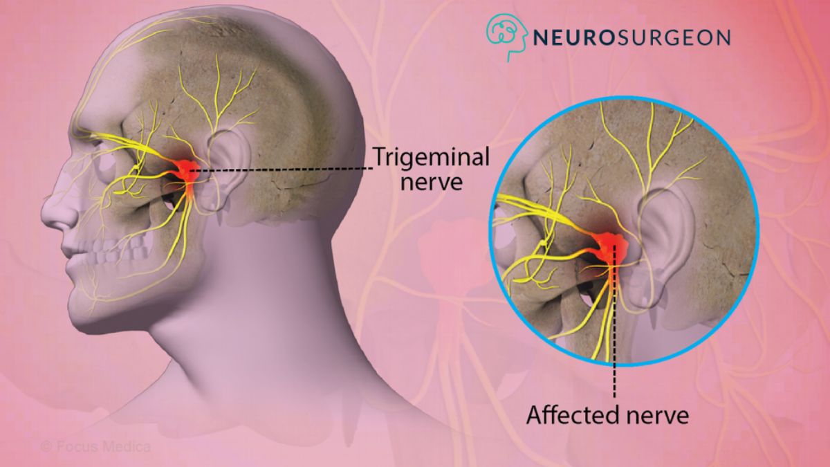 Brain Neuralgia - Dr Amit Deora a Best Neurosurgeon Doctor In Indore