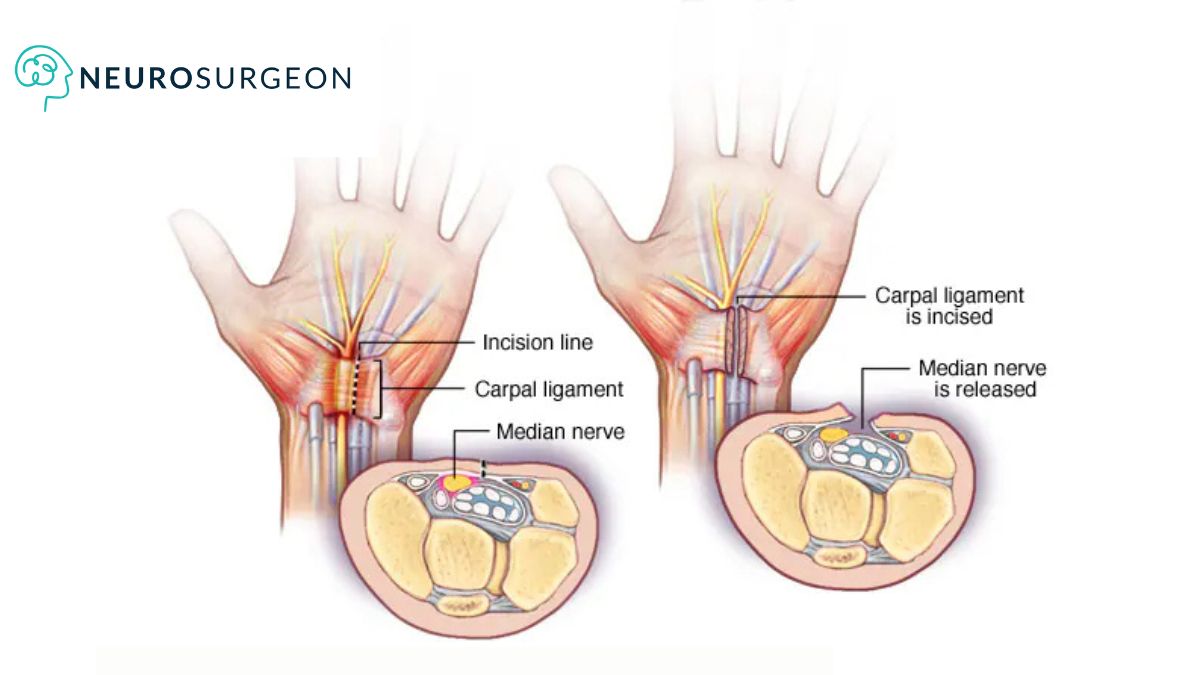 Carpal Tunnel Syndrome Described by Dr Amit Deora - Neurosurgeon Indore