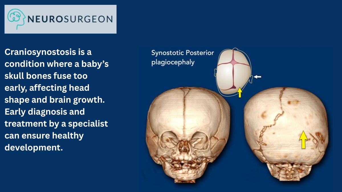 Craniosynostosis - Dr Amit Deora - Top Neurologist In Indore