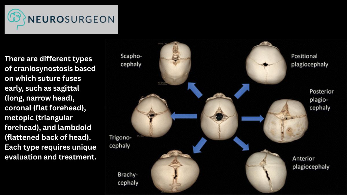 Craniosynostosis by Dr Amit Deora - Top Neurologist In Indore