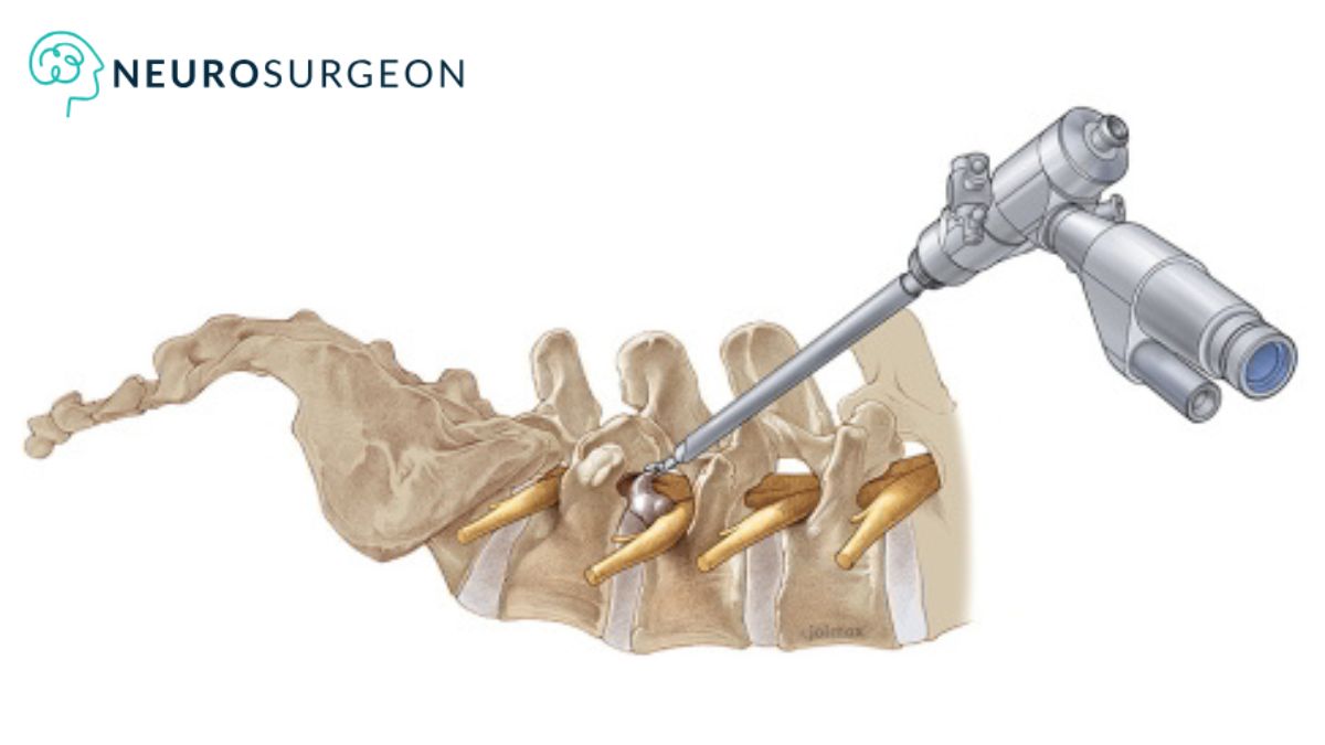 Endoscopic Spine Surgery by Dr Amit Deora - Neurosurgeon In Indore