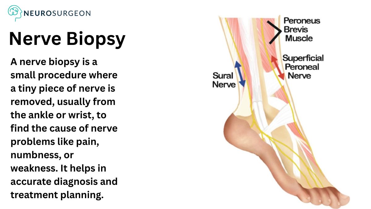 Nerve Biopsy by Dr Amit Deora - Best Neurologist In Indore