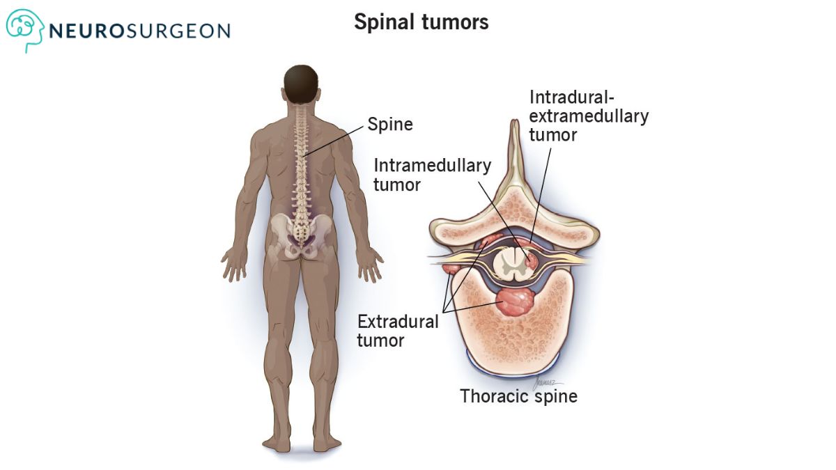 Spinal Tumor - Dr Amit Deora a Best Neurologist In Indore