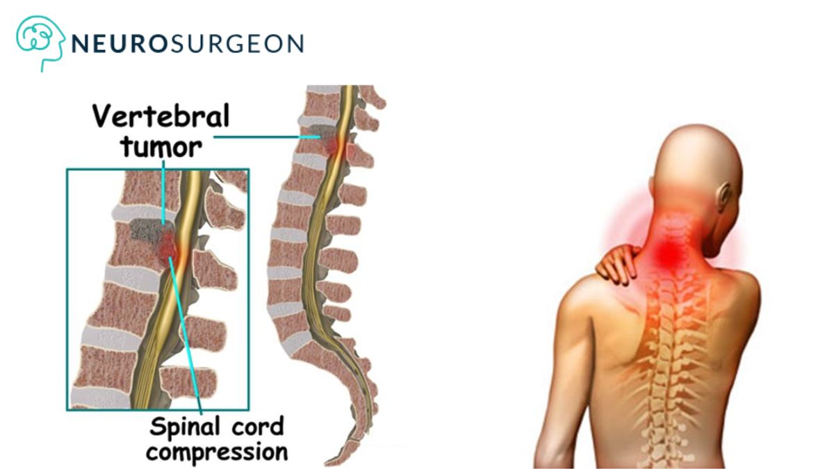 Spinal Tumor by Dr Amit deora - Best Neurologist In Indore