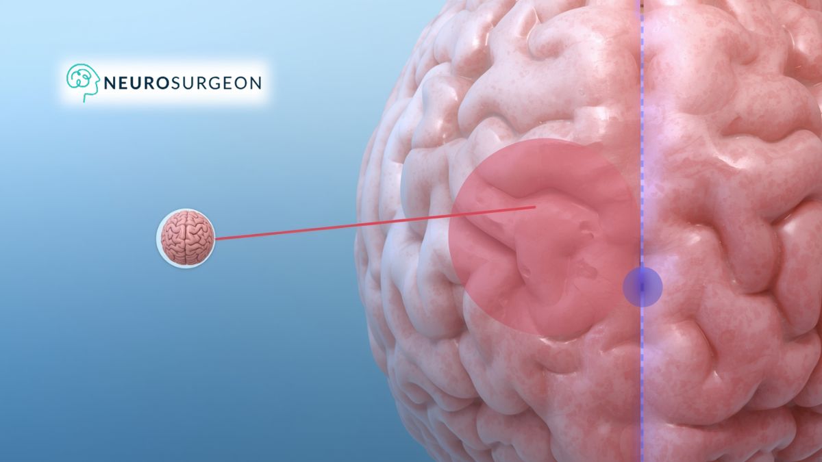 How Long Does Endoscopic Brain Surgery Take