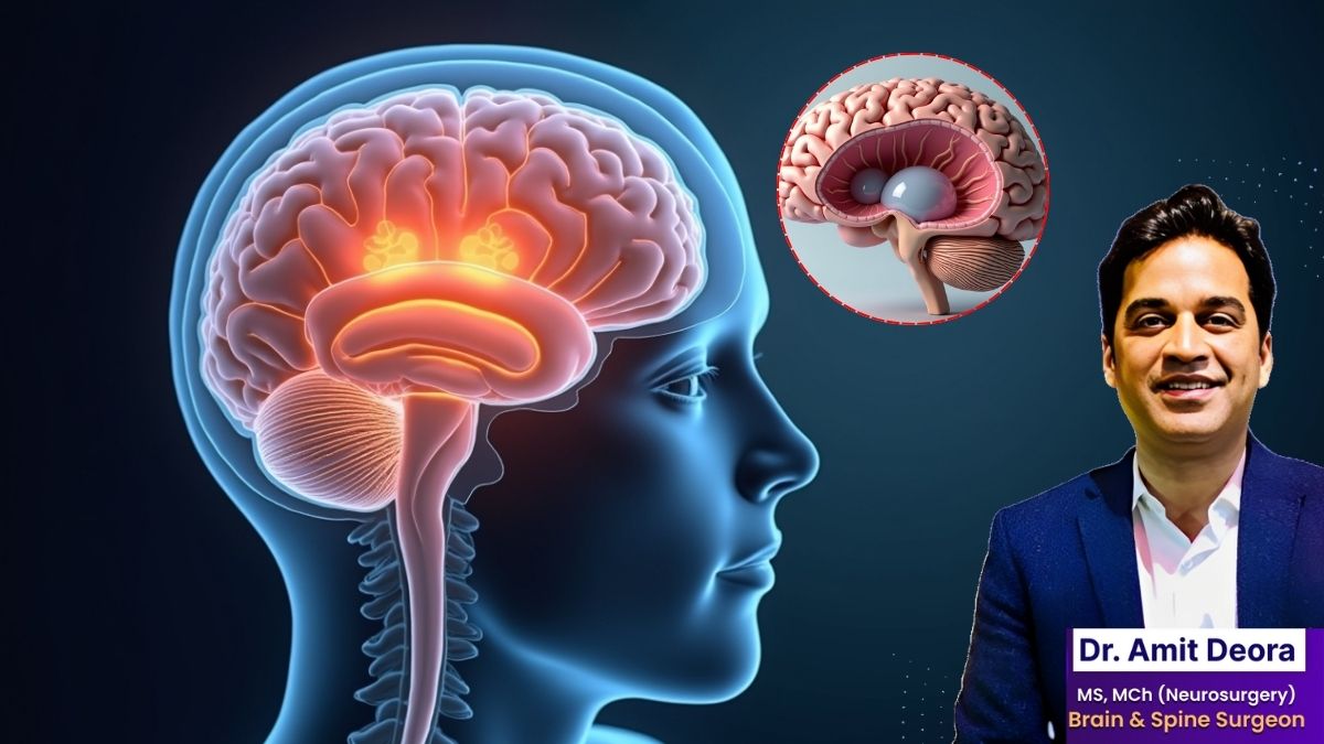 ब्रेन में पानी भरना (हाइड्रोसिफ़लस) एक गंभीर लेकिन इलाज योग्य बीमारी है।