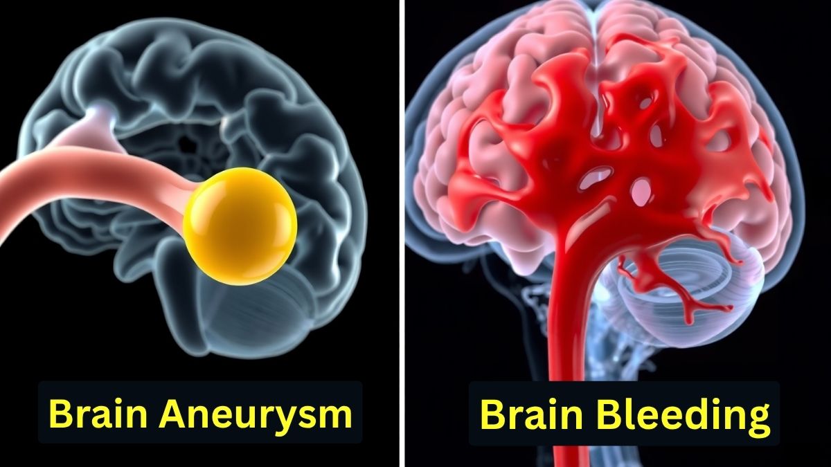 Brain hemorrhage and brain aneurysm - Neurosurgeon in Indore