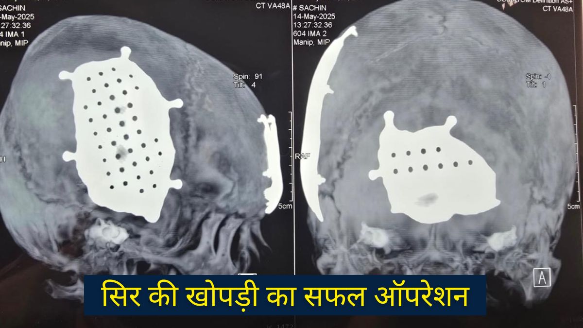 सिर में चोट ka safal operation