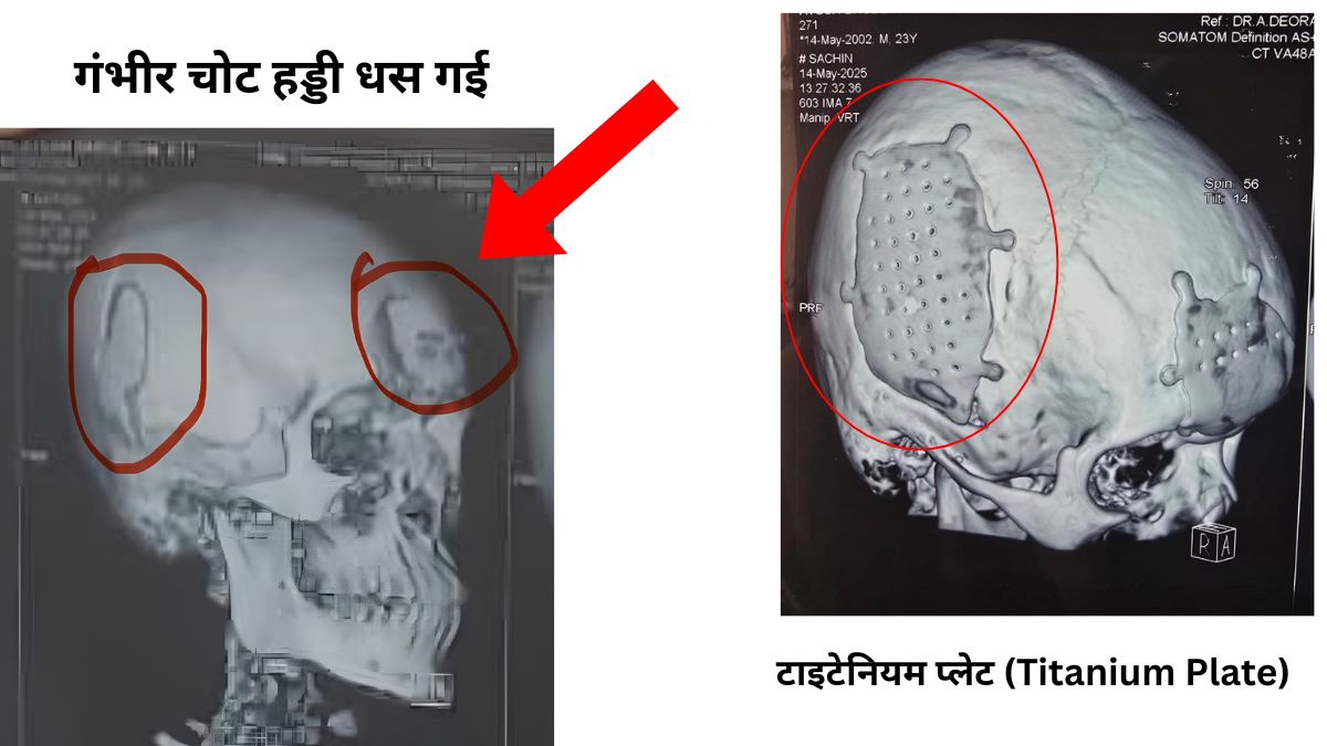 सिर में चोट