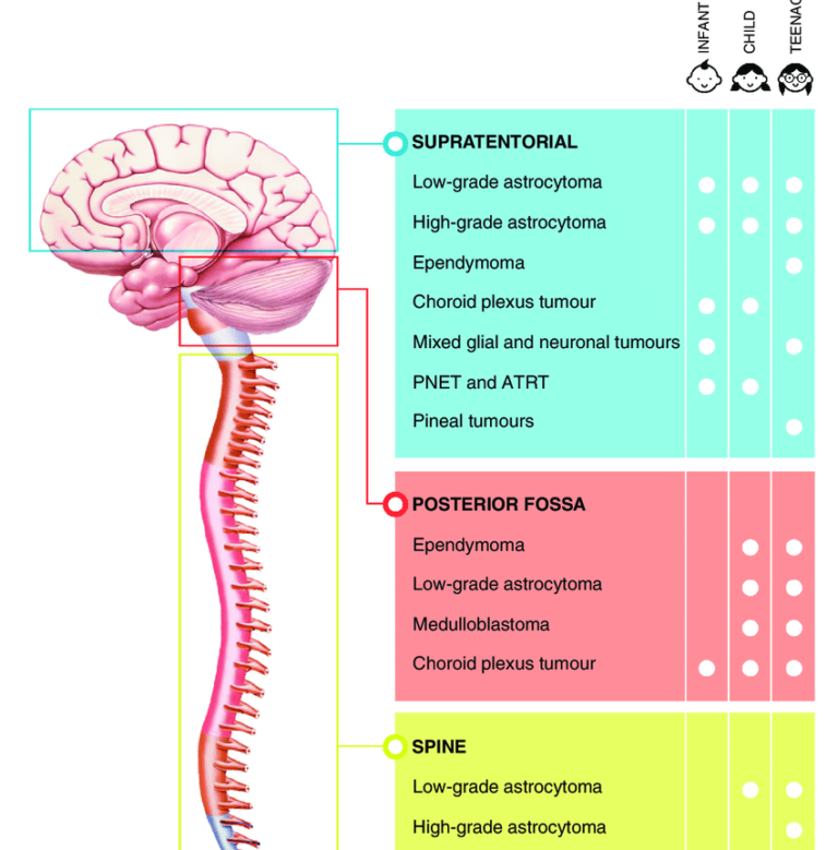 Tumors Paediatric