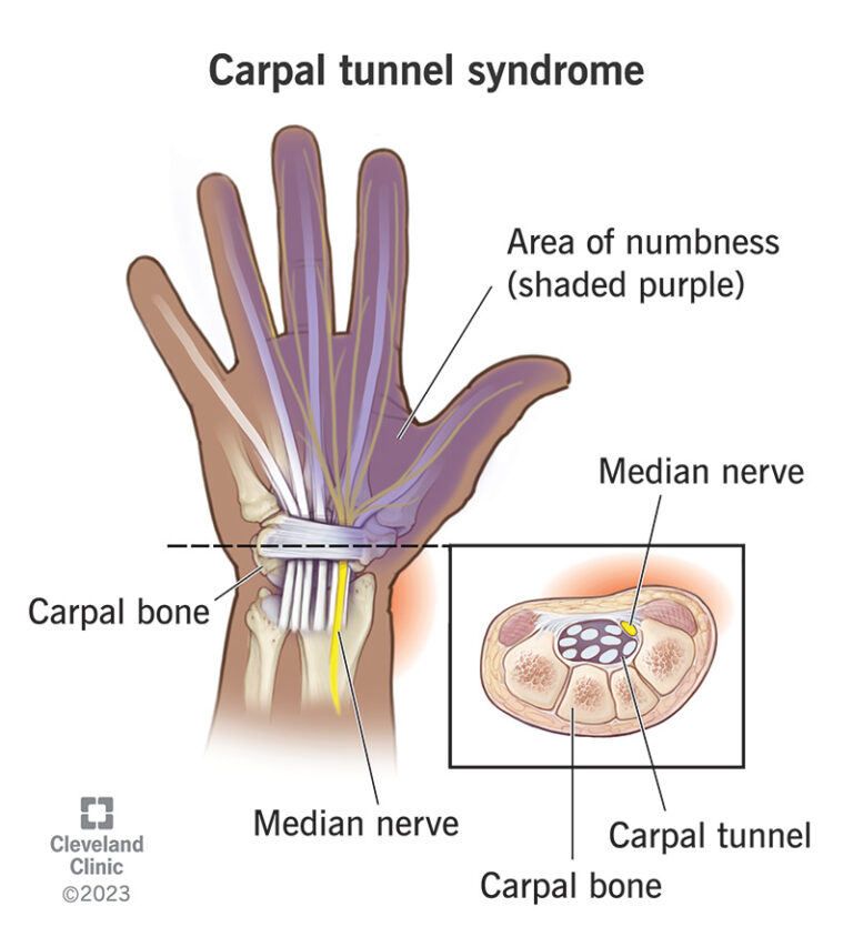 Carpal Tunel Syndrome