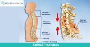spinal-fracture-Dr Amit Deora-Best Neurosurgeon Doctor In Indore