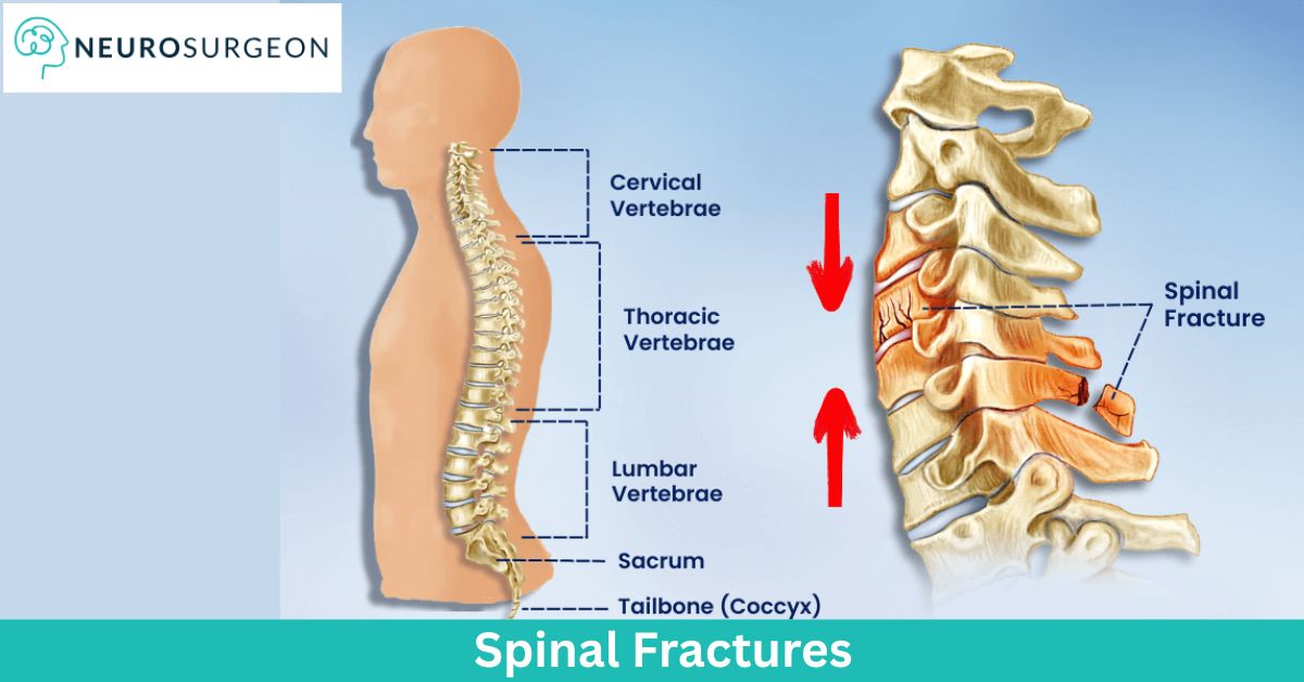 spinal-fracture-Dr Amit Deora-Best Neurosurgeon Doctor In Indore