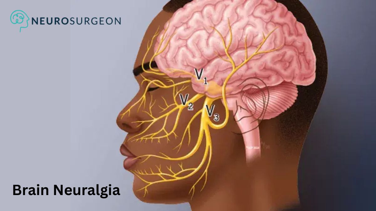 Brain Neuralgia - Dr Amit Deora - Best Neurosurgeon In Indore