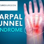 carpal-tunnel-syndrome by Dr Amit Deora - neurosurgeon indore