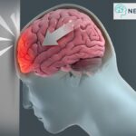 Head Injury - Dr Amit Deora - Best Neurologist in Indore