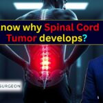 Everything You Need to Know About Spinal Cord Tumors Risks, Surgery & Expert Care