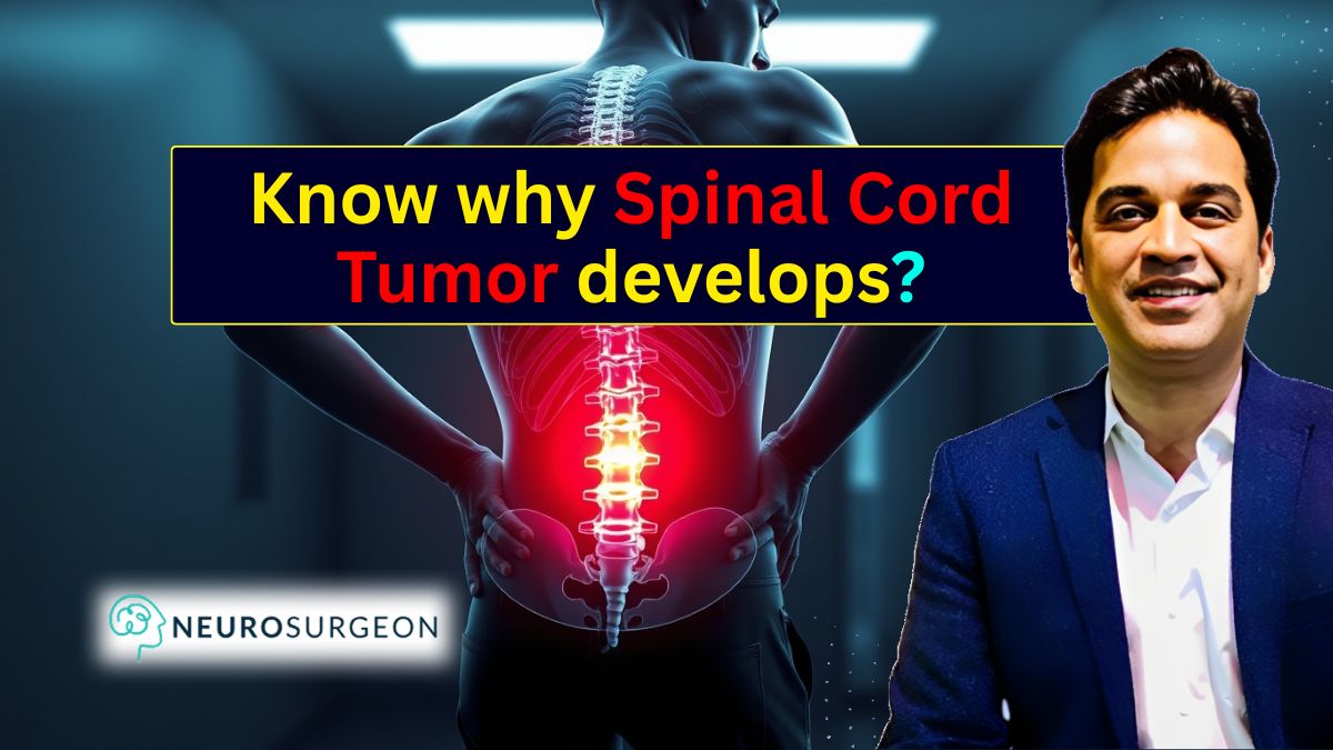 Everything You Need to Know About Spinal Cord Tumors Risks, Surgery & Expert Care