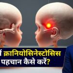 बच्चों में क्रानियोसिनेस्टोसिस