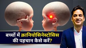 बच्चों में क्रानियोसिनेस्टोसिस