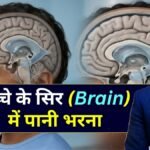 बच्चे के सिर में पानी भरना - Dr Amit Deora Best Neurologist in Indore