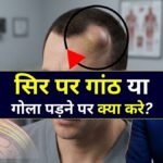 सिर पर गांठ पड़ने पर क्या करें